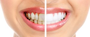 december-teeth-whitening1
