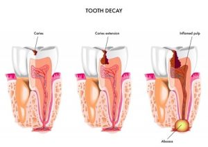 toothdecay